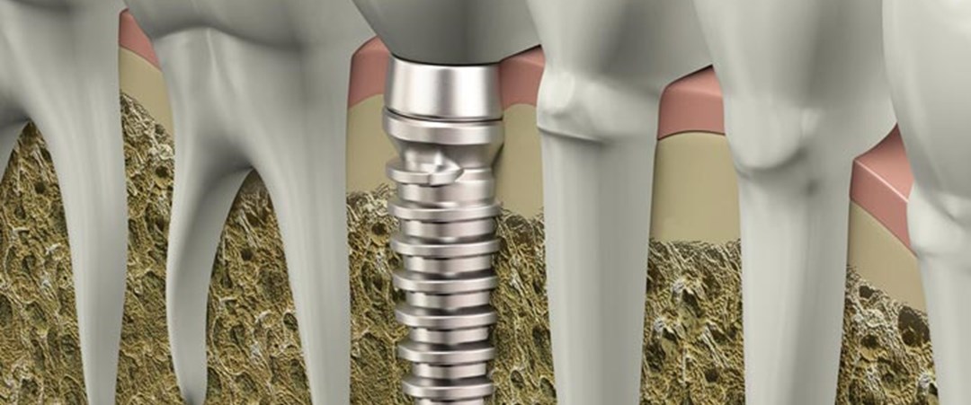 Имплант зуба онкология. Биосовместимые импланты. Классическая имплантация. Анималистические импланты. Остеоинтеграция.