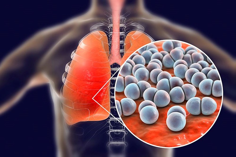 Strep A 9 çocuğu öldürdü: Küresel endişeye neden olan Strep A nedir, belirtileri neler ve Türkiye'de görüldü mü? - 2