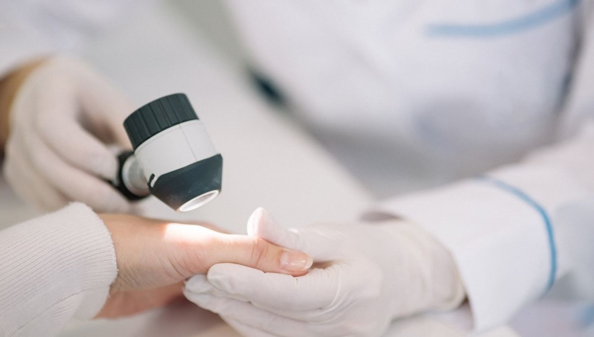 Cilt kanseri olan doktor görmezden geldiği belirtiyi açıkladı: Meğer vücuduna yayılmış