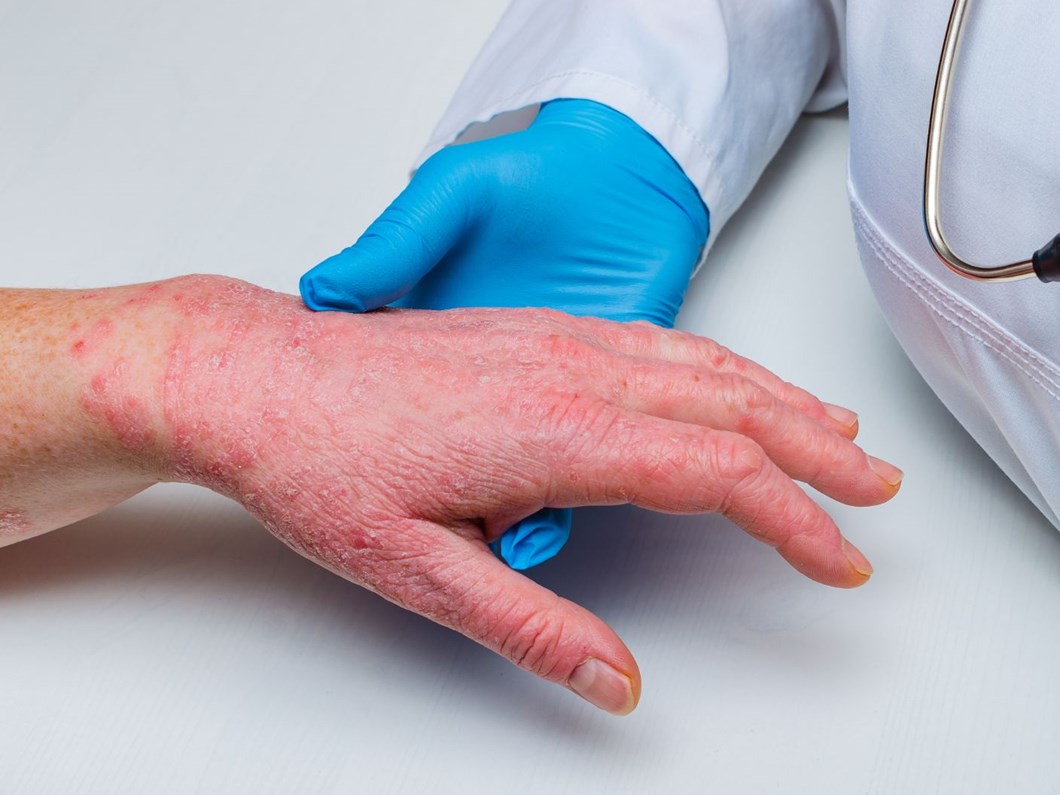 sedef hastaligi nedir belirtileri nelerdir sedef hastaligi nasil tedavi edilir