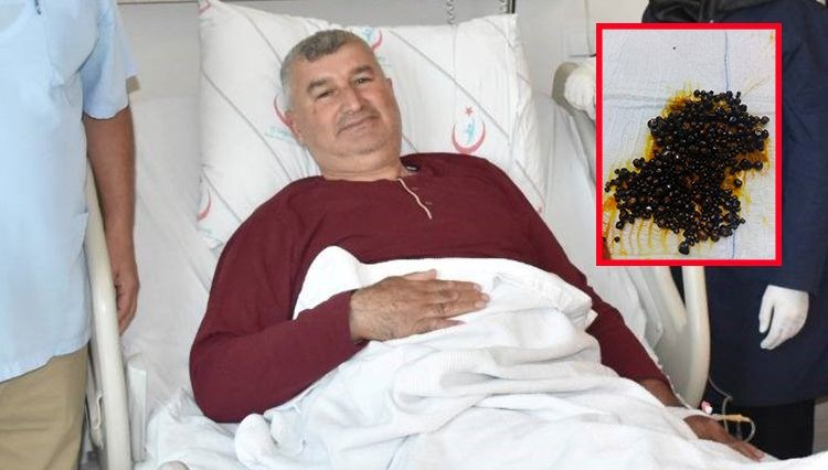 Doktorlar bile şaşırdı: Hepsi safra kesesinden çıkarıldı