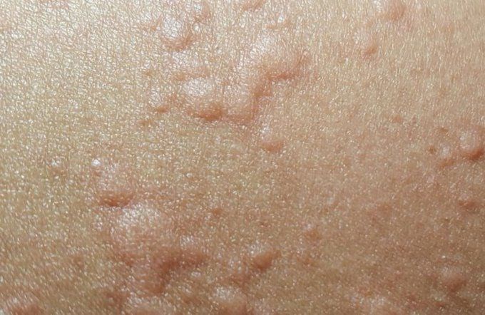 corona virusun cildinizde neden olabilecegi semptomlar saglik haberleri ntv