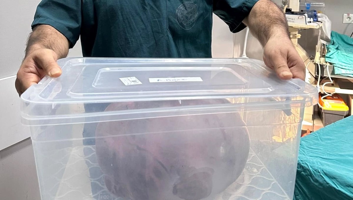 Yumurtalıklarında 9 kiloluk kitle çıktı