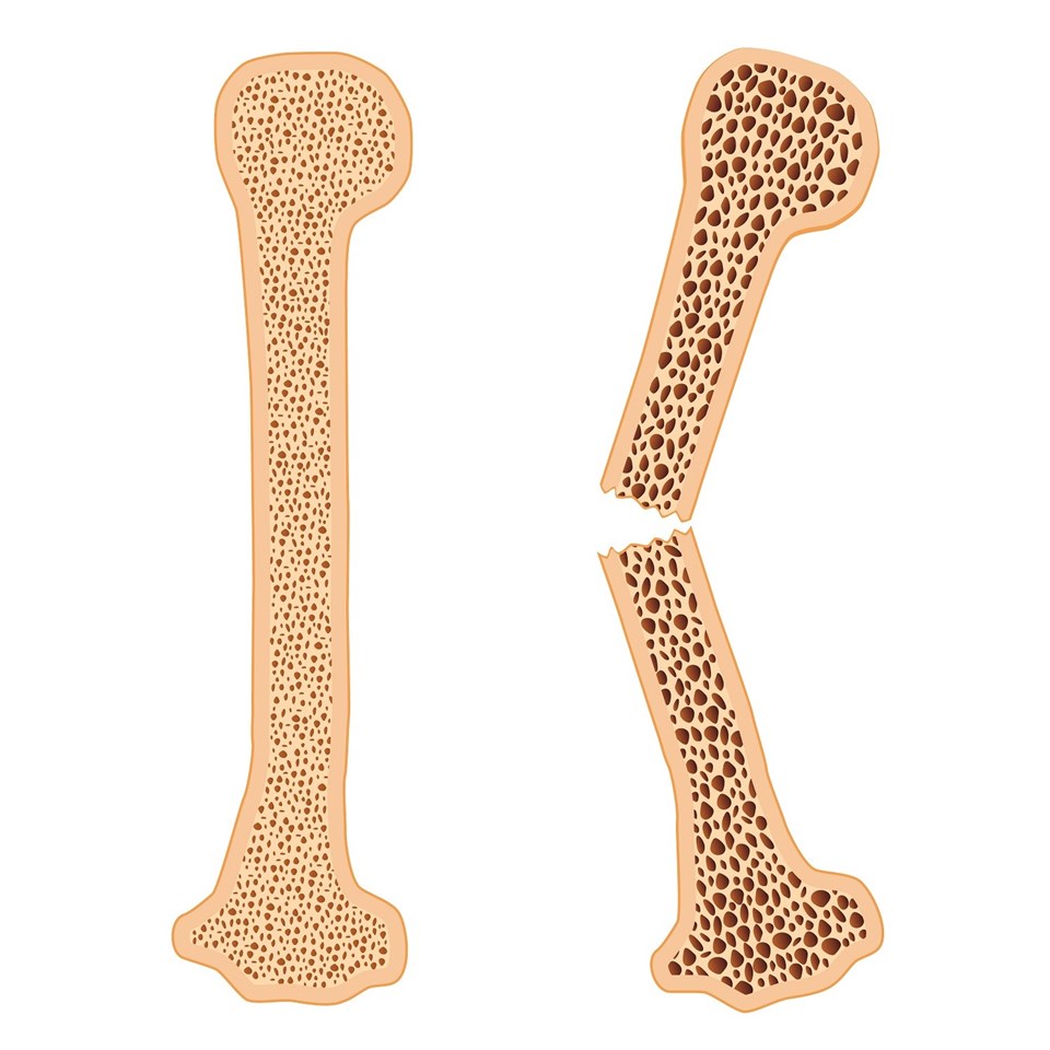 Kemik erimesi (Osteoporoz) genetik kaynaklı olabilir! - 1