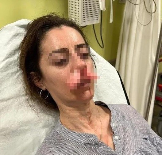 Otomobilin kapısı defalarca kez suratına çarpılan kadın feci şekilde yaralandı.