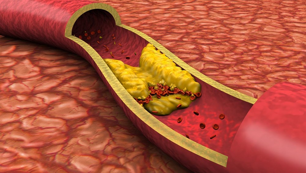 Het wordt genegeerd, maar het is een teken van een hoog cholesterol: de meeste mensen hebben dit symptoom - 6