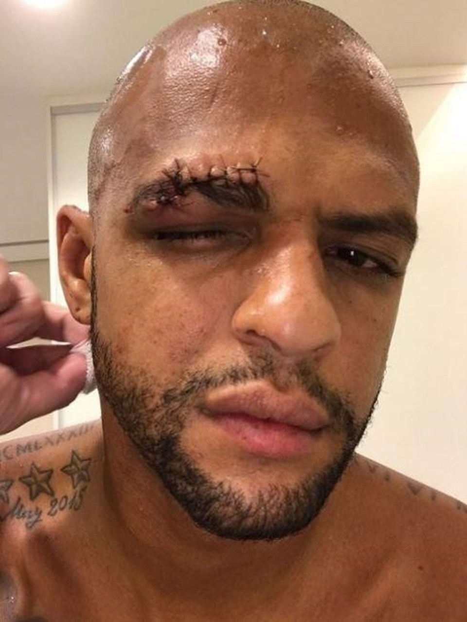 Felipe Melo'nun kaşı açıldı - 2