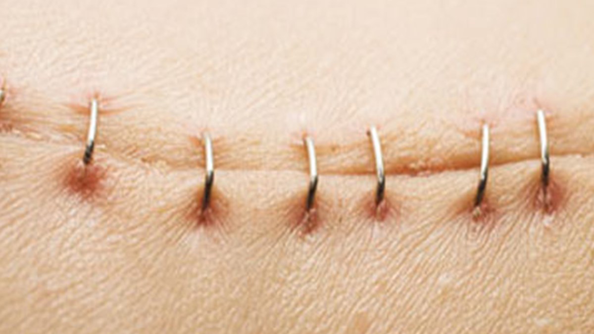 yara mutlaka iz birakir saglik haberleri ntv