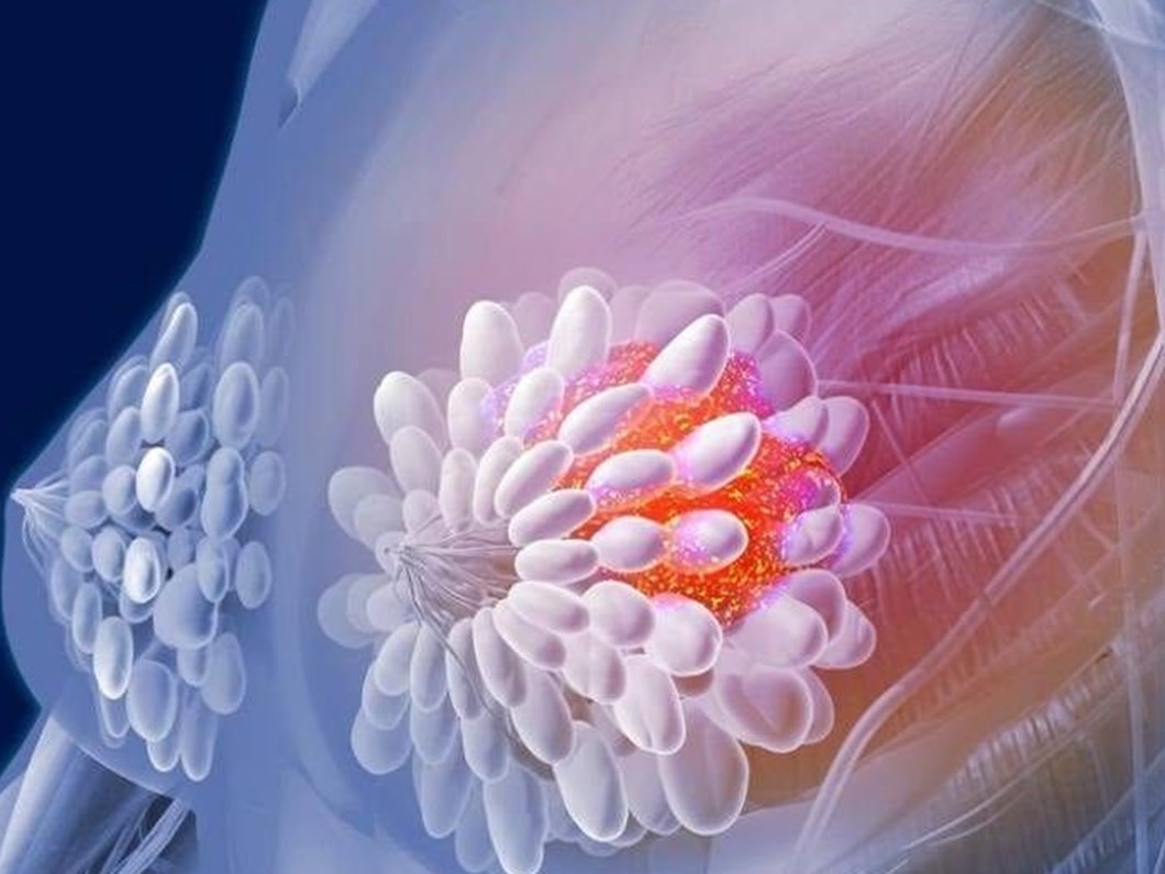 meme kistleri kansere donusmez