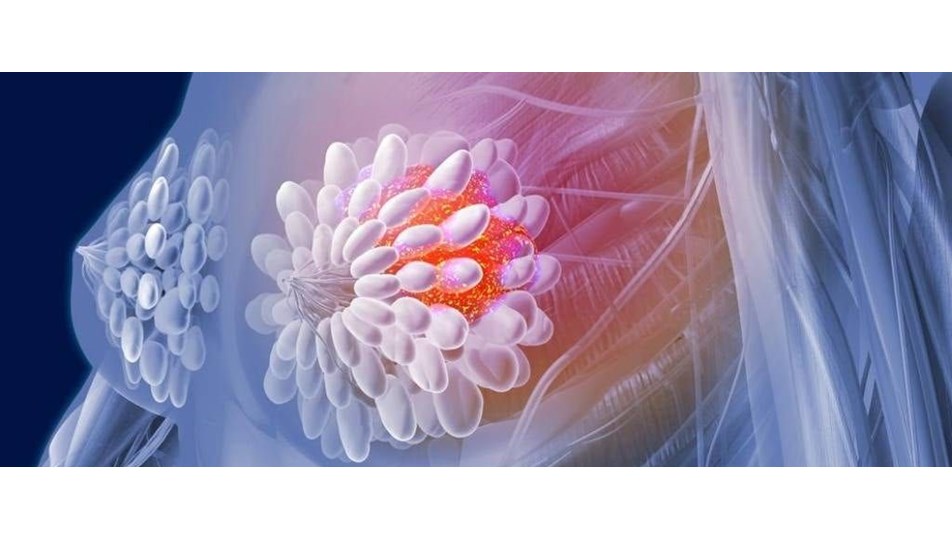 meme kistleri kansere donusmez