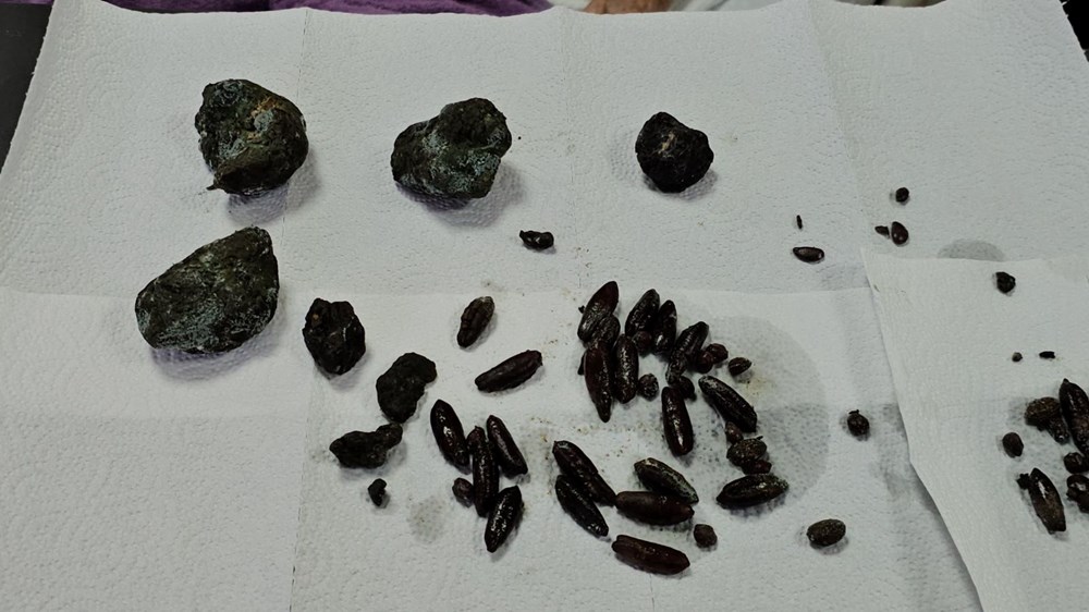 92 yaşındaki kadının midesinden ve bağırsaklarından çıktı: Kaç senedir yiyordum, zarar vereceğini düşünmedim - 2