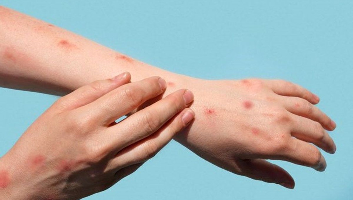 Almanya'da yeni M-çiçeği virüsü varyantı Almanya'da yeni M-çiçeği virüsü varyantı