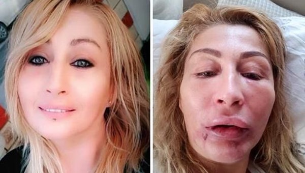 Antalya'da kadının dudağı estetikten sonra çürüdü (Prof. Özlenen Özkan, NTV'de uyarılarda bulundu)