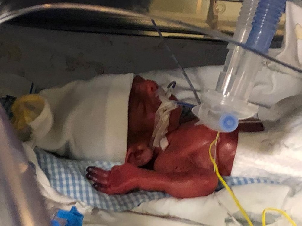 648 gram doğdu, 3 ay yoğun bakımda kaldı: Umut bebek hayata tutunmayı başardı - 4
