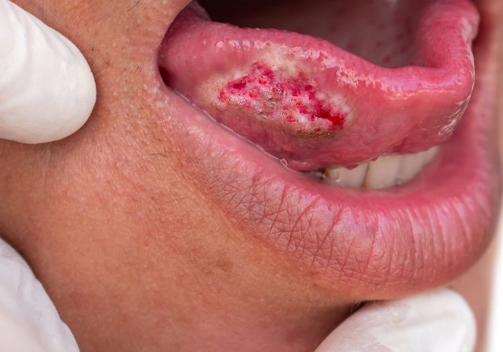 Migren Sandığı Kanser: 36 Yaşındaki Kadının Gözden Kaçırdığı 4 Uyarı Sinyali 72 wjkHwvE8g0uBbiMmPdpTZw