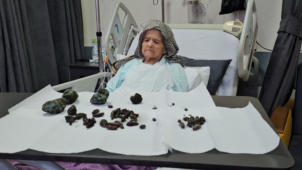 92 yaşındaki kadının midesinden ve bağırsaklarından çıktı: Kaç senedir yiyordum, zarar vereceğini düşünmedim - 3