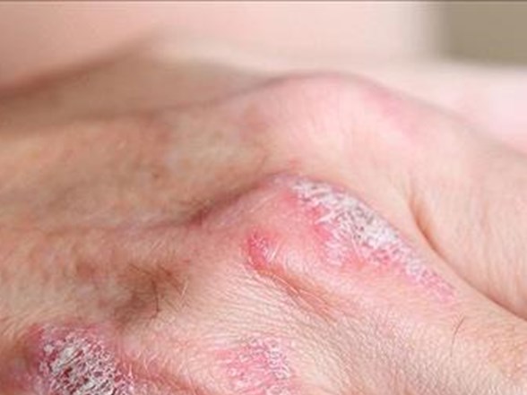 erkeklerde kansizlik neyin habercisi