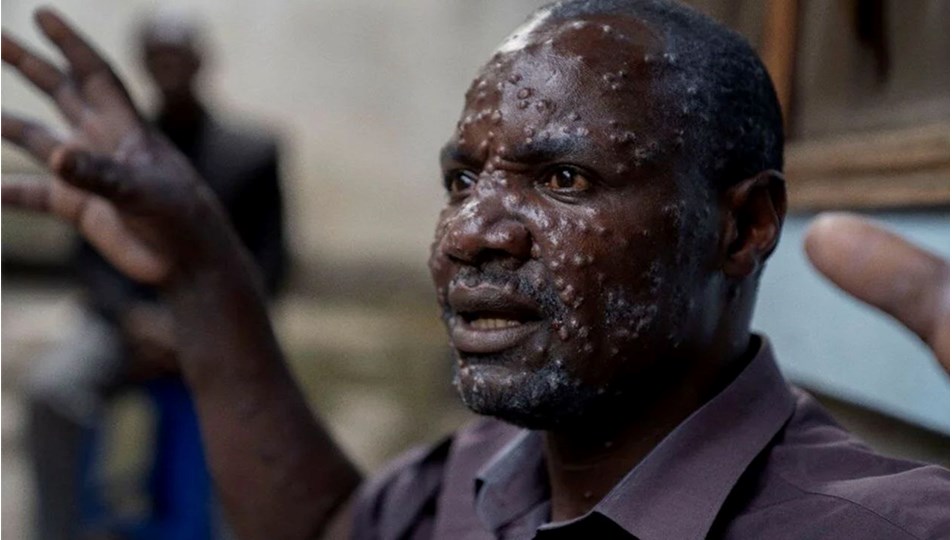 M çiçeği salgınında korkutan artış: Sierra Leone'de virüs patladı