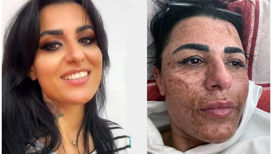 Güzellik merkezinde yüzü yanan Aslı: Sosyal medyadaki reklamlarına kandım