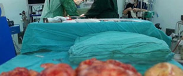 Midesinden 8 kilogram tümör çıktı