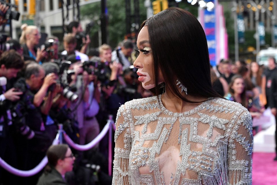 Winnie Harlow, Vitiligo hastalığı
