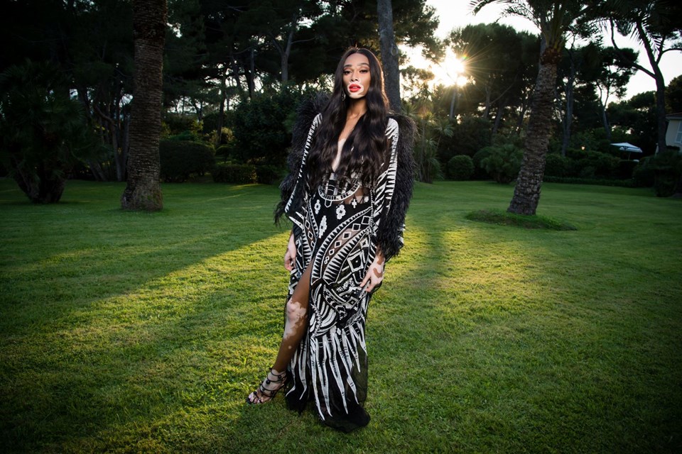 Winnie Harlow, Vitiligo hastalığı