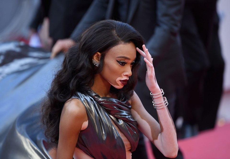 Winnie Harlow, Vitiligo hastalığı