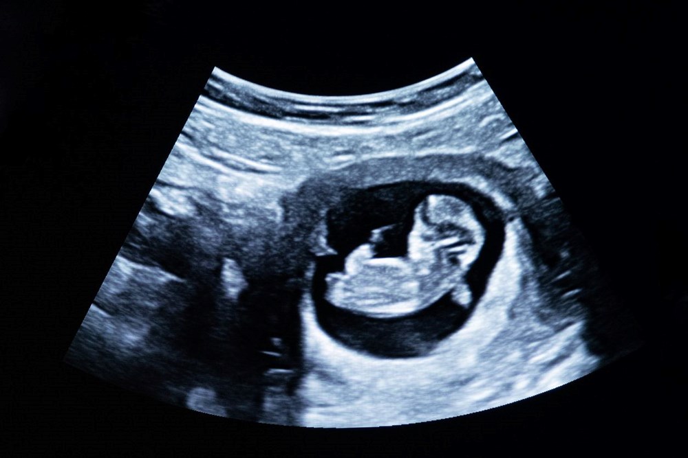 Anne adaylarına uyarı: Hamilelik öncesinde alkol tüketimi bebeklerin yüzünün değişmesine neden oluyor - 2
