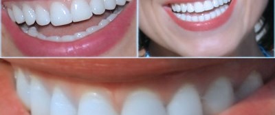 Curuk Dis Bir Cok Hastaligi Cagiriyor