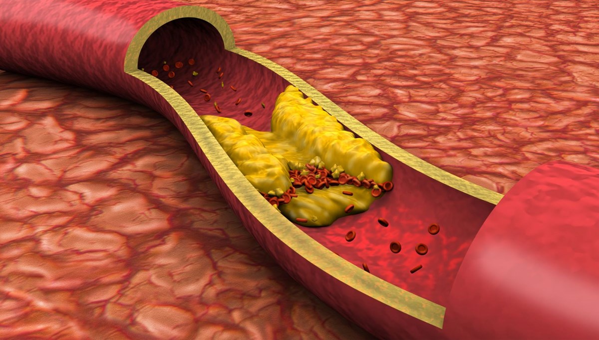 Kolesterolü gen tedavisi düşürecek