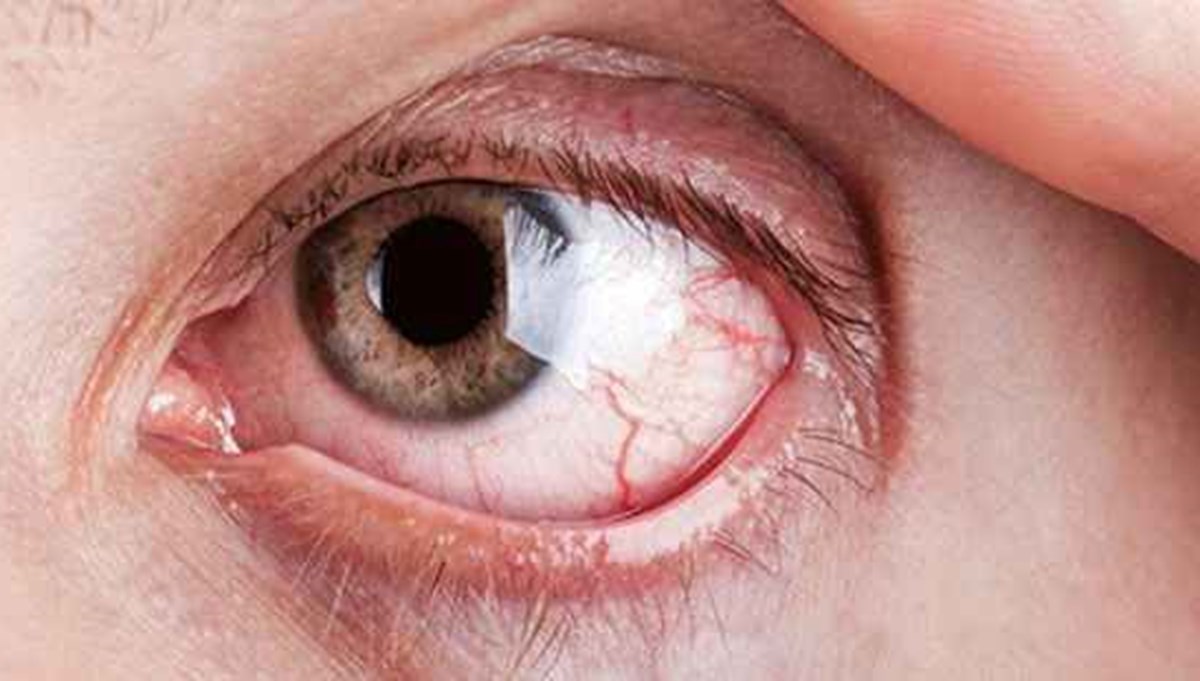 Göz kanlanması nedir? Göz kanlanmasına ne iyi gelir? | HarbiMekân.com