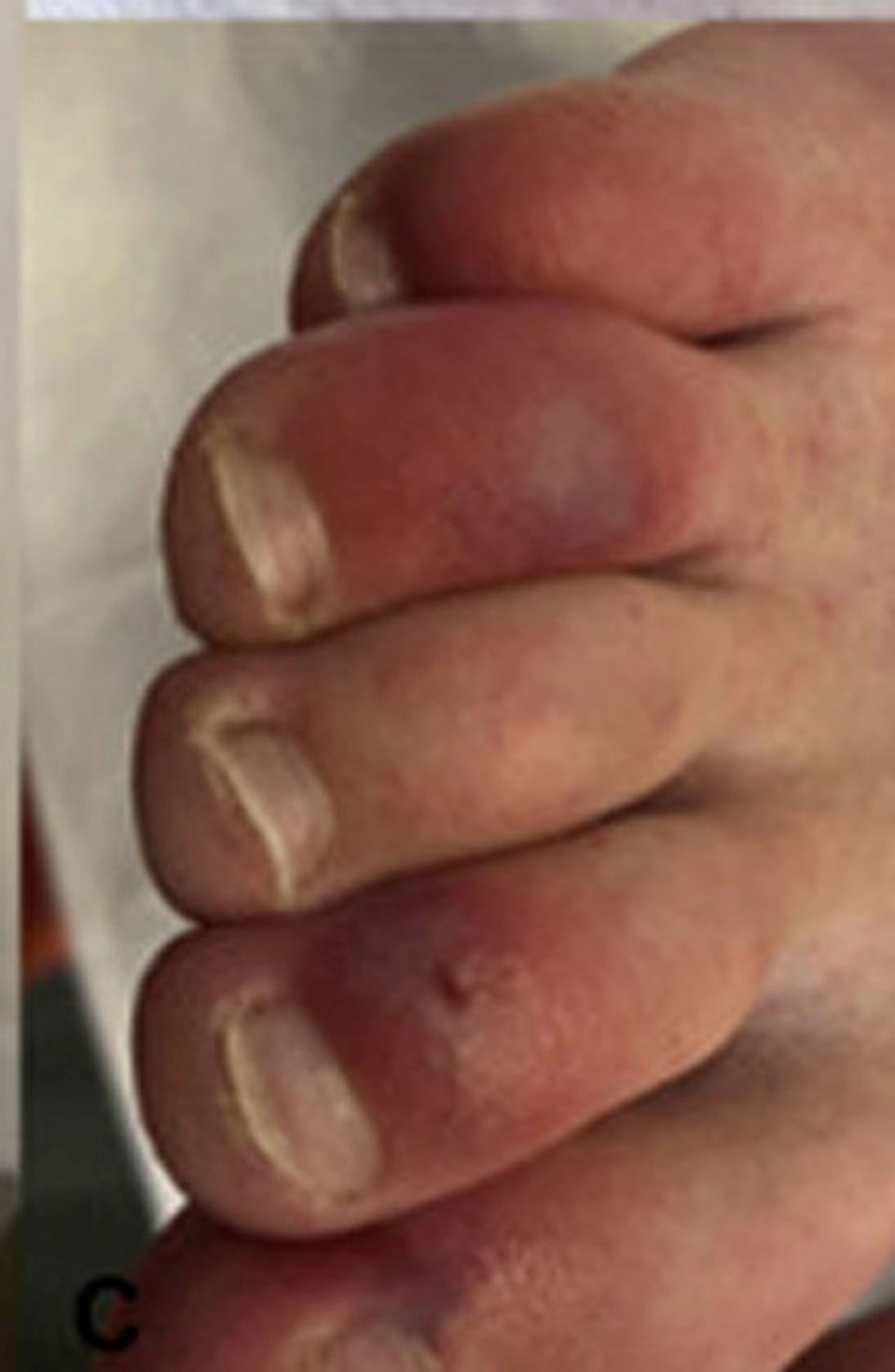 Corona virüsün ciltteki hasarı beş aydan daha uzun sürebilir: Covid ayak parmakları - 2