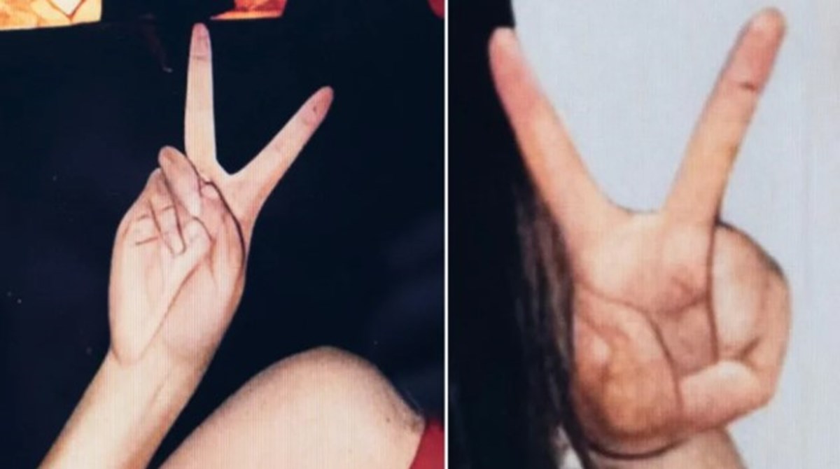 Belgeselde kullanılan fotoğrafta deforme olmuş eller. | Netflix Belgeselde kullanılan fotoğrafta deforme olmuş eller. | Netflix